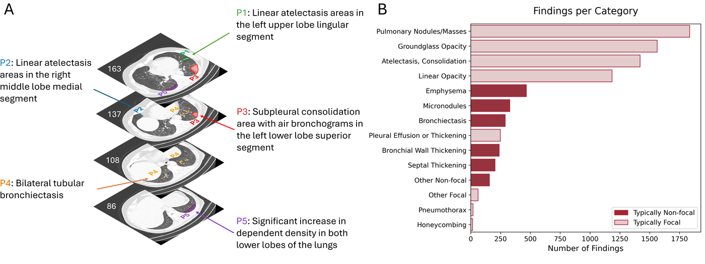 Figure from the paper: grounding free-text CT findings to pixel-level segmentations